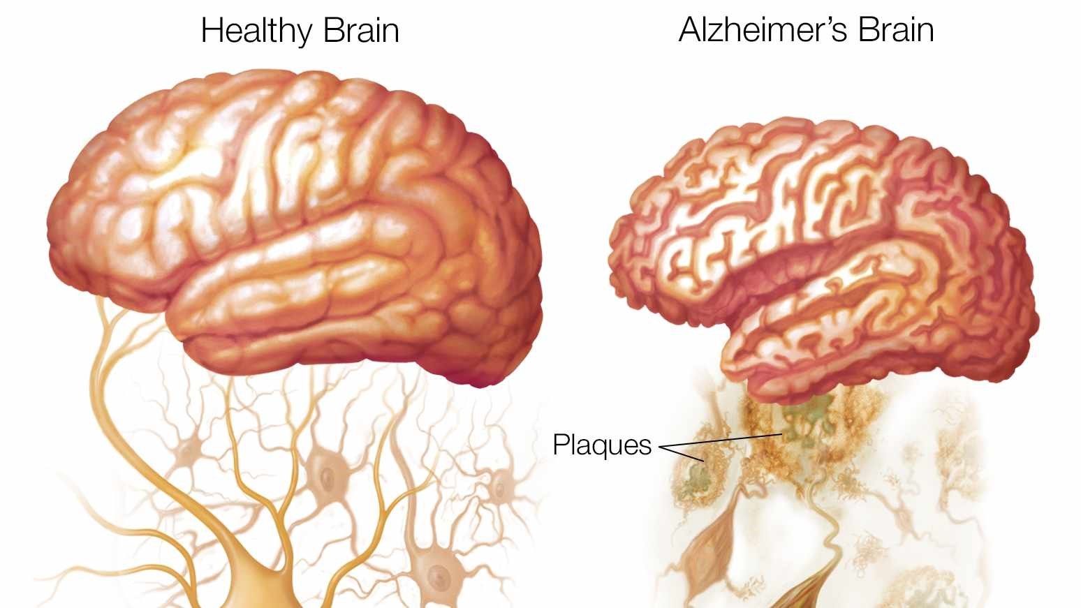 Pregnenolone - Tăng cường chức năng nhận thức ở bệnh nhân Alzheimer 3