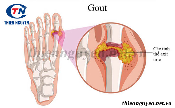 bệnh Gout là gì? nguyên nhân gây ra bệnh gout