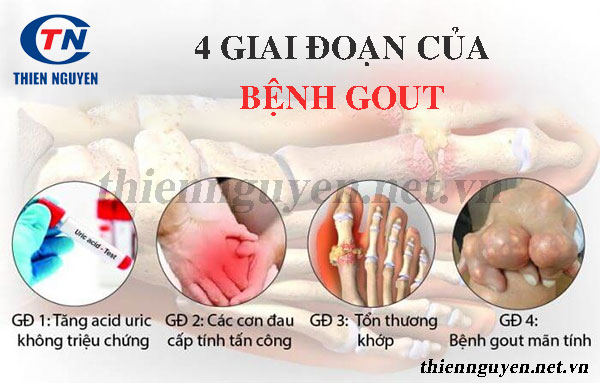 triệu chứng của gout